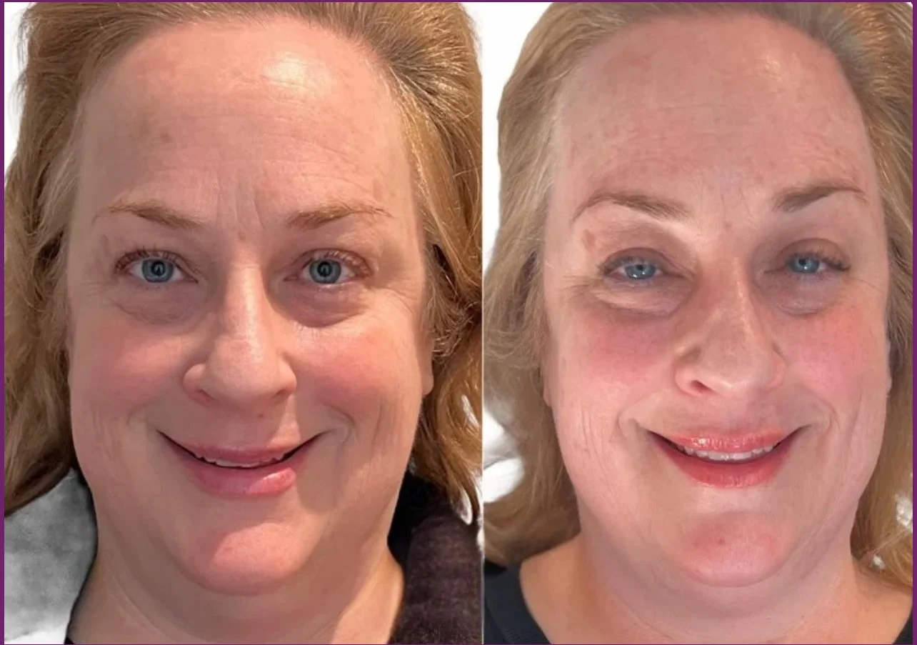 Side-by-side comparison of a woman's face before and after cosmetic treatment, showing reduced wrinkles and smoother skin.