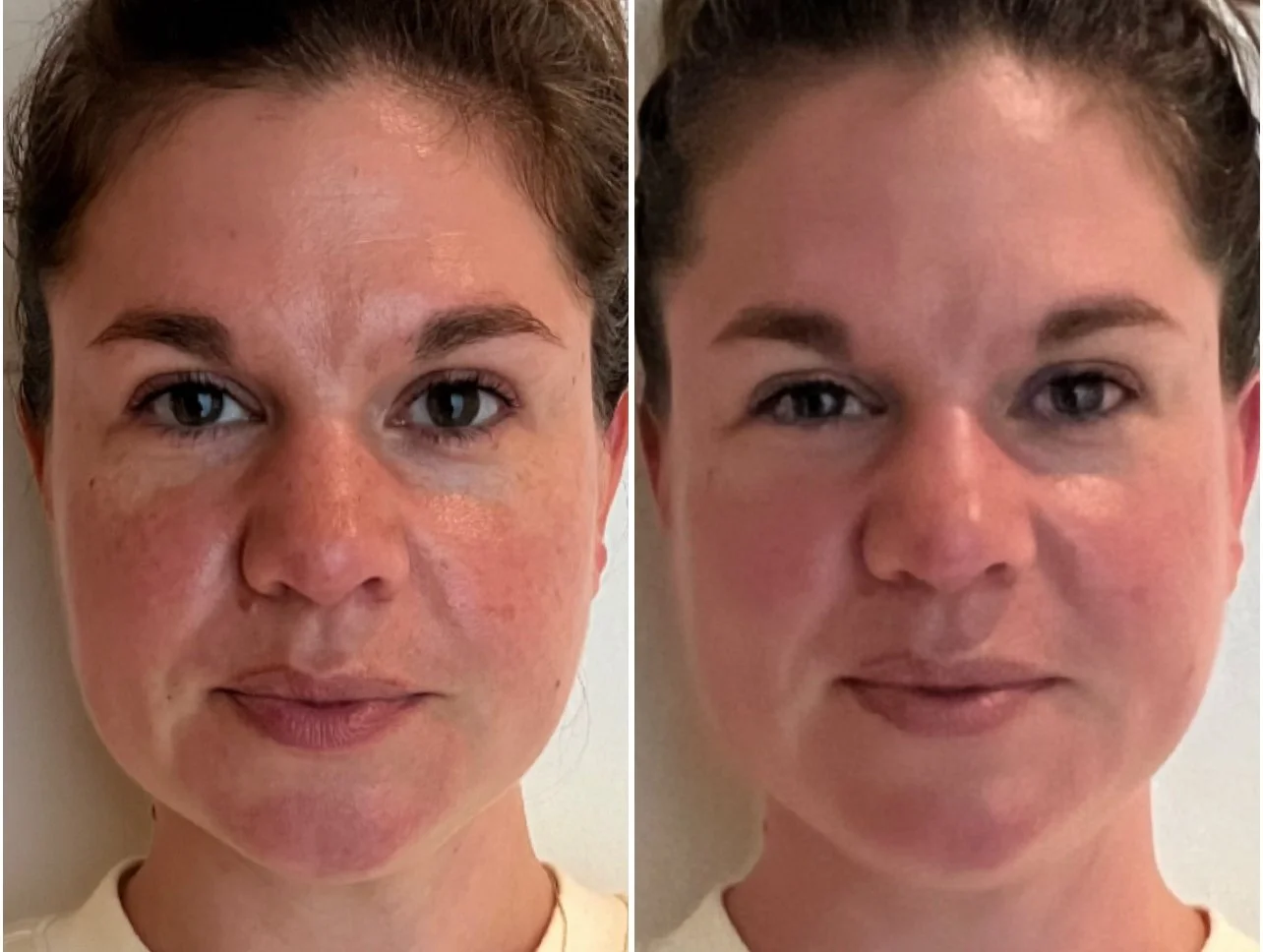Comparison of a woman’s face before and after skincare, showing clearer skin on the right.