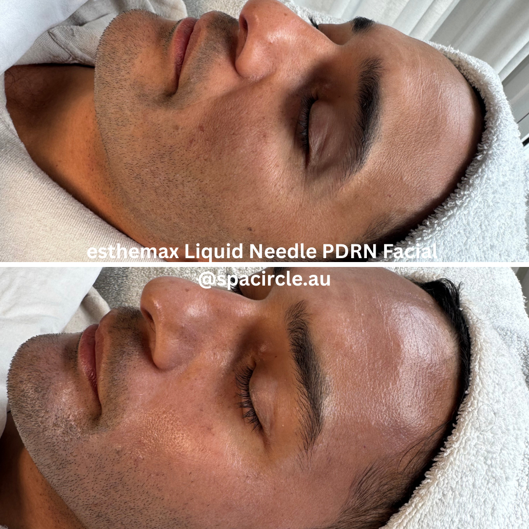 esthemax liquid needle pdrn 1.png