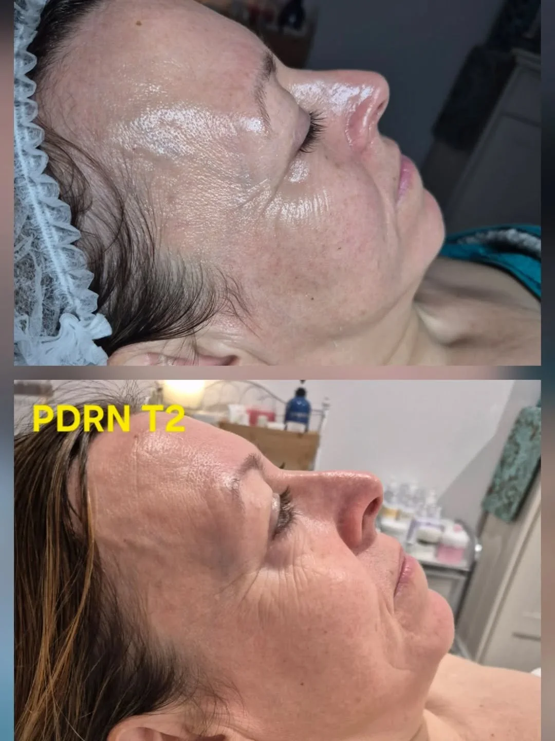 Liquid Needle PDRN progress 🤍 Bulimba, QLD 
#Repost from @beautifulyoubynadia PDRN liquid needle treatment for Skin Regeneration.

🌿 we focussed on high impact zones
🌿 client wanted a refresh
🌿 gorgeous lymphatic face massage included
🌿 PDRN Spi