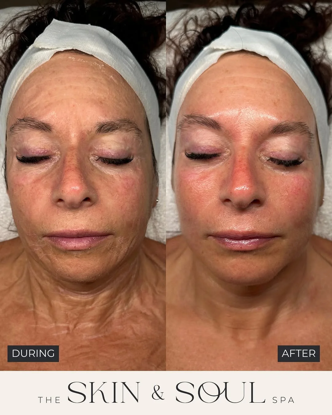 #Repost from @theskinandsoulspa The &ldquo;Faux Tox&rdquo; Lymphatic Sculpting Facial ⚡️⁠
⁠
That tight, wrinkly phase you see during the mask?⁠
⁠
That&rsquo;s the contour effect activating.⁠
⁠
This treatment features the Esthemax Argireline Contour M