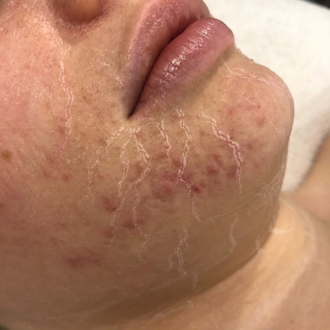 #Repost from @thedermalclinique This facial isn&rsquo;t just for fine lines and wrinkles but also for any skin type in need of some nourishing! ⠀⠀⠀⠀⠀⠀⠀⠀⠀
⠀⠀⠀⠀⠀⠀⠀⠀⠀
It&rsquo;s a tightening treatment mask designed to work with your circulatory system -