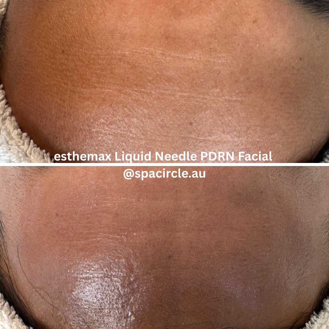 esthemax liquid needle pdrn 2.png