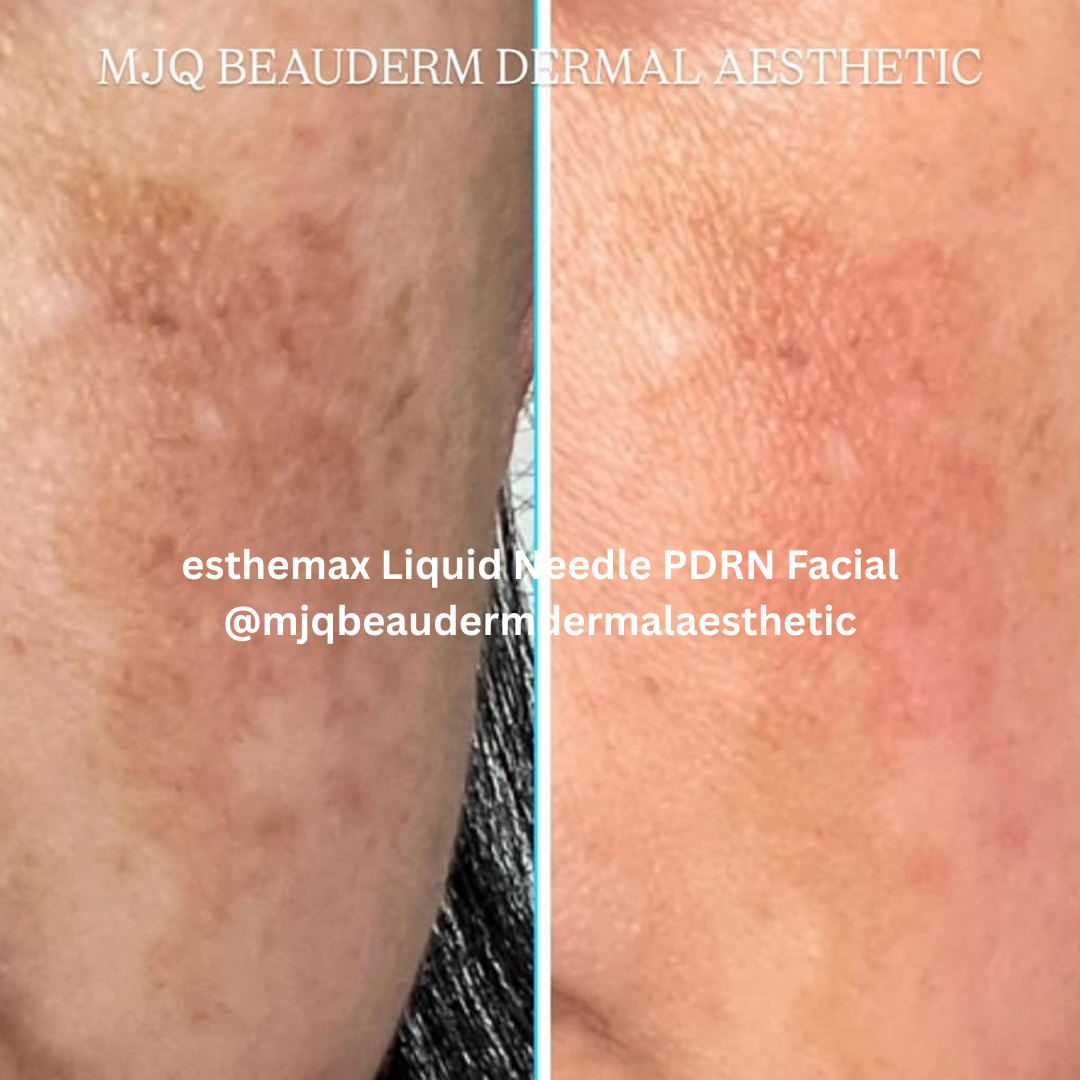 esthemax liquid needle pdrn Australia 1.png