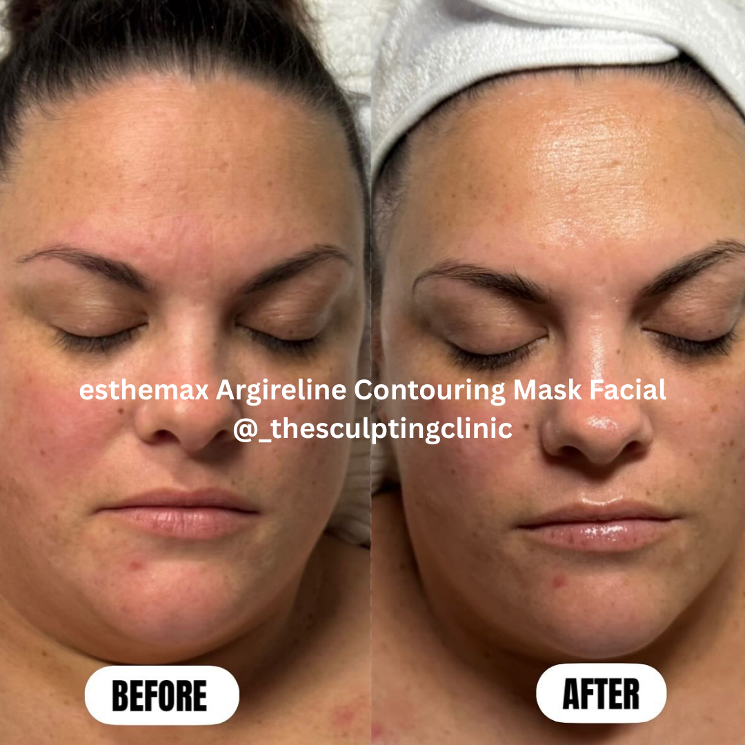 esthemax argireline contouring mask results Australia 2.png