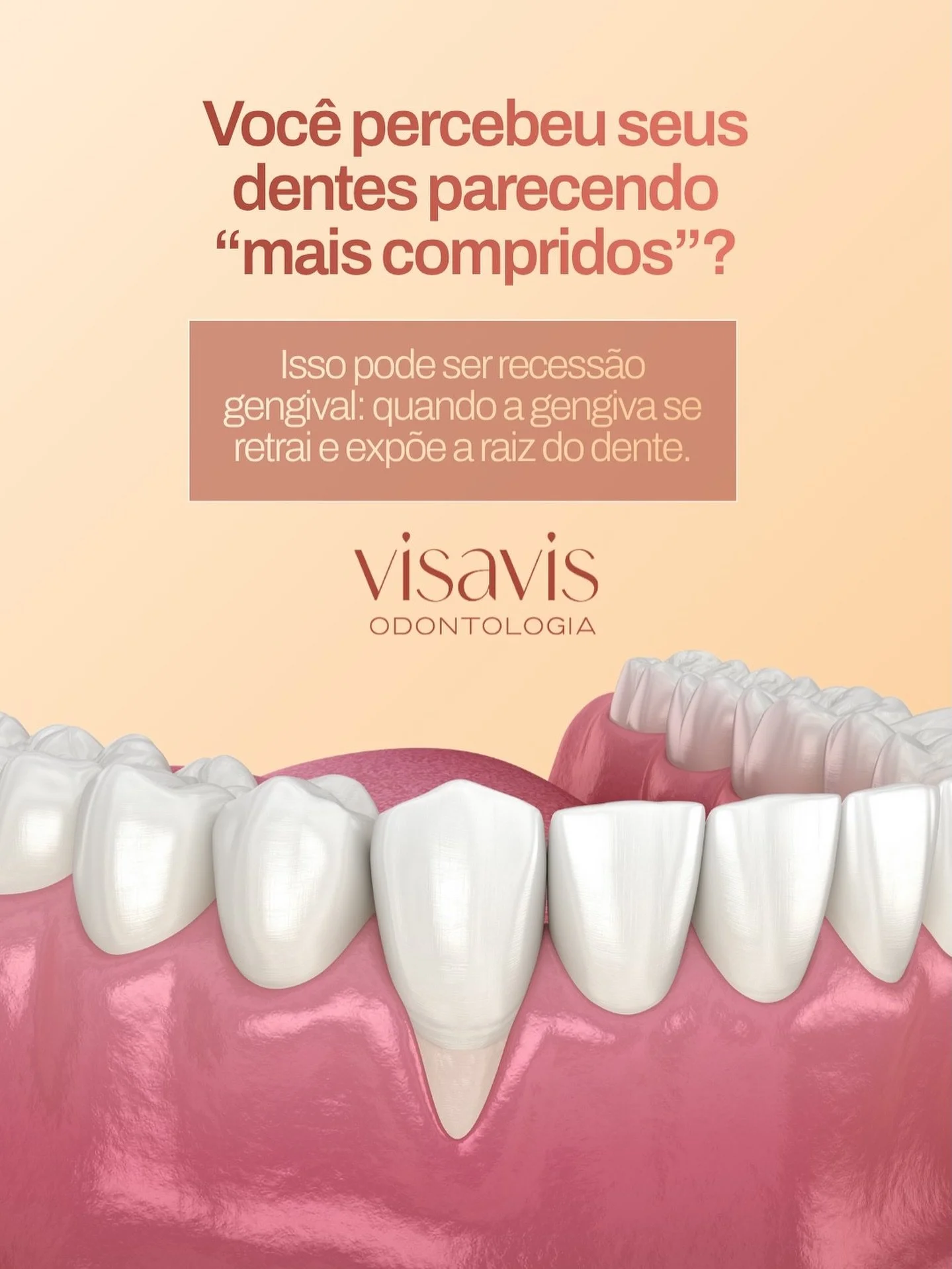 Seus dentes est&atilde;o parecendo &ldquo;mais compridos&rdquo;? Isso pode ser recess&atilde;o gengival! 😬

A recess&atilde;o ocorre quando a gengiva se retrai, deixando a raiz do dente exposta. Al&eacute;m da perda de prote&ccedil;&atilde;o da raiz