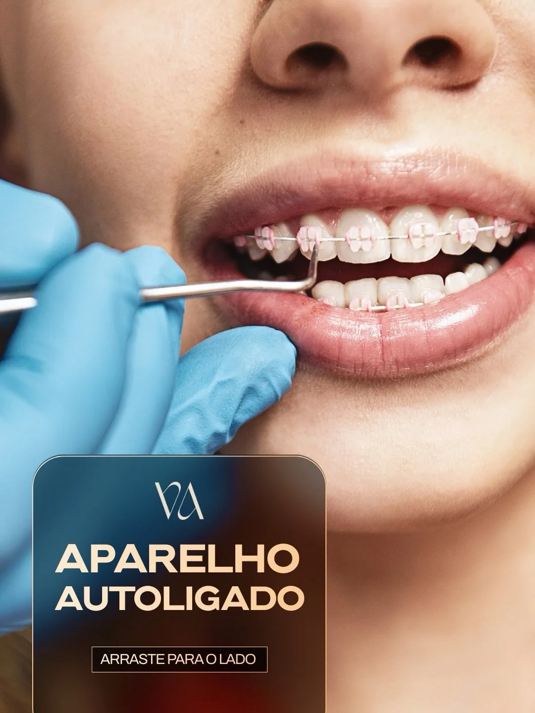 A ortodontia evoluiu e o seu tratamento tamb&eacute;m pode evoluir.
O sistema autoligado utiliza tecnologia que reduz atrito, melhora a efici&ecirc;ncia mec&acirc;nica e pode otimizar o tempo de tratamento.
Mais conforto.
Menos consultas.
Resultados 