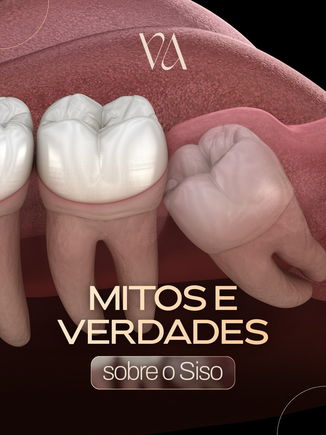 A experi&ecirc;ncia da cirurgia do siso depende muito mais da t&eacute;cnica do que do procedimento em si.

Quando realizada por um especialista em Cirurgia Bucomaxilofacial, com planejamento adequado e protocolos modernos, o trauma &eacute; reduzido