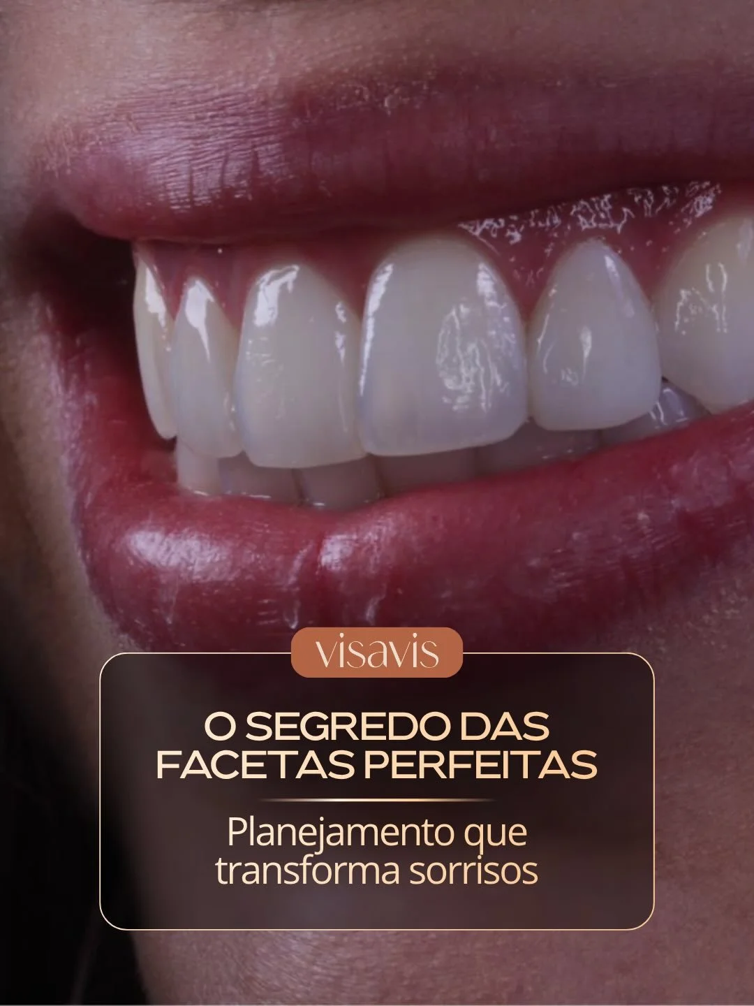 Facetas de excel&ecirc;ncia n&atilde;o s&atilde;o fruto de improviso.
S&atilde;o resultado de planejamento minucioso, estudo facial e trabalho conjunto entre especialistas.
Antes de qualquer preparo, analisamos propor&ccedil;&otilde;es, formato do ro