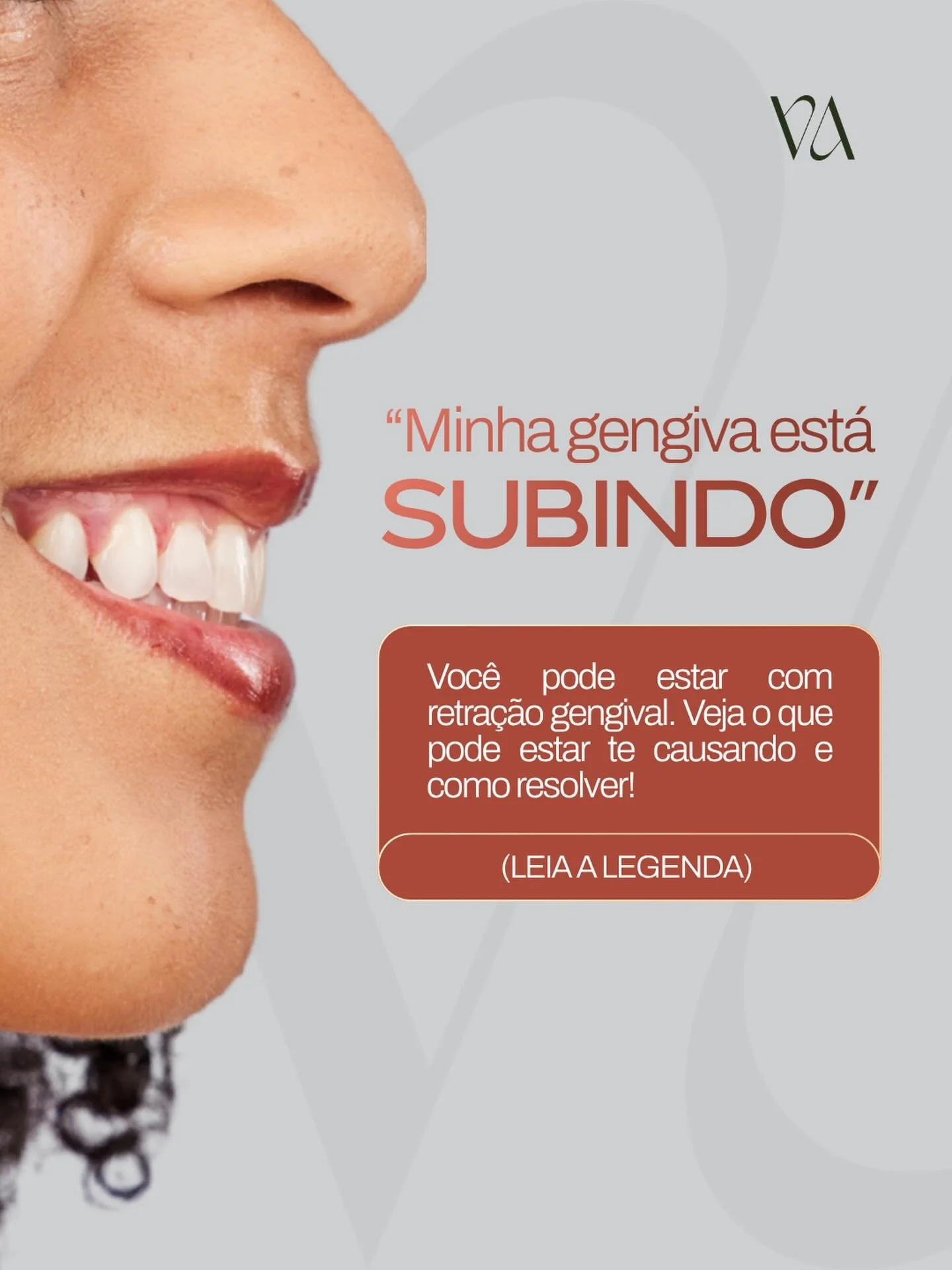 &ldquo;Minha gengiva est&aacute; subindo&hellip;&rdquo; ⚠️

Isso pode ser um sinal de retra&ccedil;&atilde;o gengival, um problema mais comum do que parece e que pode causar sensibilidade, desconforto e at&eacute; comprometer a sa&uacute;de dos dente