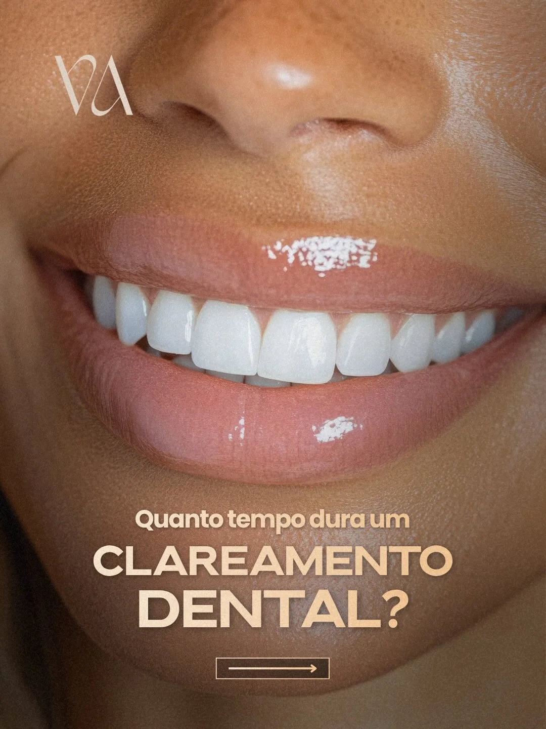 Seu sorriso mais claro n&atilde;o dura para sempre&hellip; mas pode durar muito mais ✨

O clareamento dental pode durar de 1 a 3 anos, dependendo dos seus h&aacute;bitos no dia a dia.

Com os cuidados certos e uma manuten&ccedil;&atilde;o simples, &e