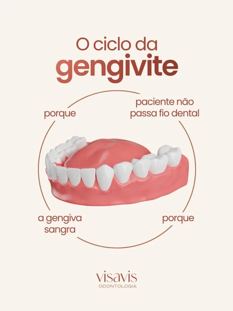 Sangramento na gengiva n&atilde;o deve ser considerado normal 🦷

Na maioria das vezes, esse &eacute; um dos primeiros sinais da gengivite, uma inflama&ccedil;&atilde;o causada pelo ac&uacute;mulo de placa bacteriana entre os dentes e a gengiva.

E d