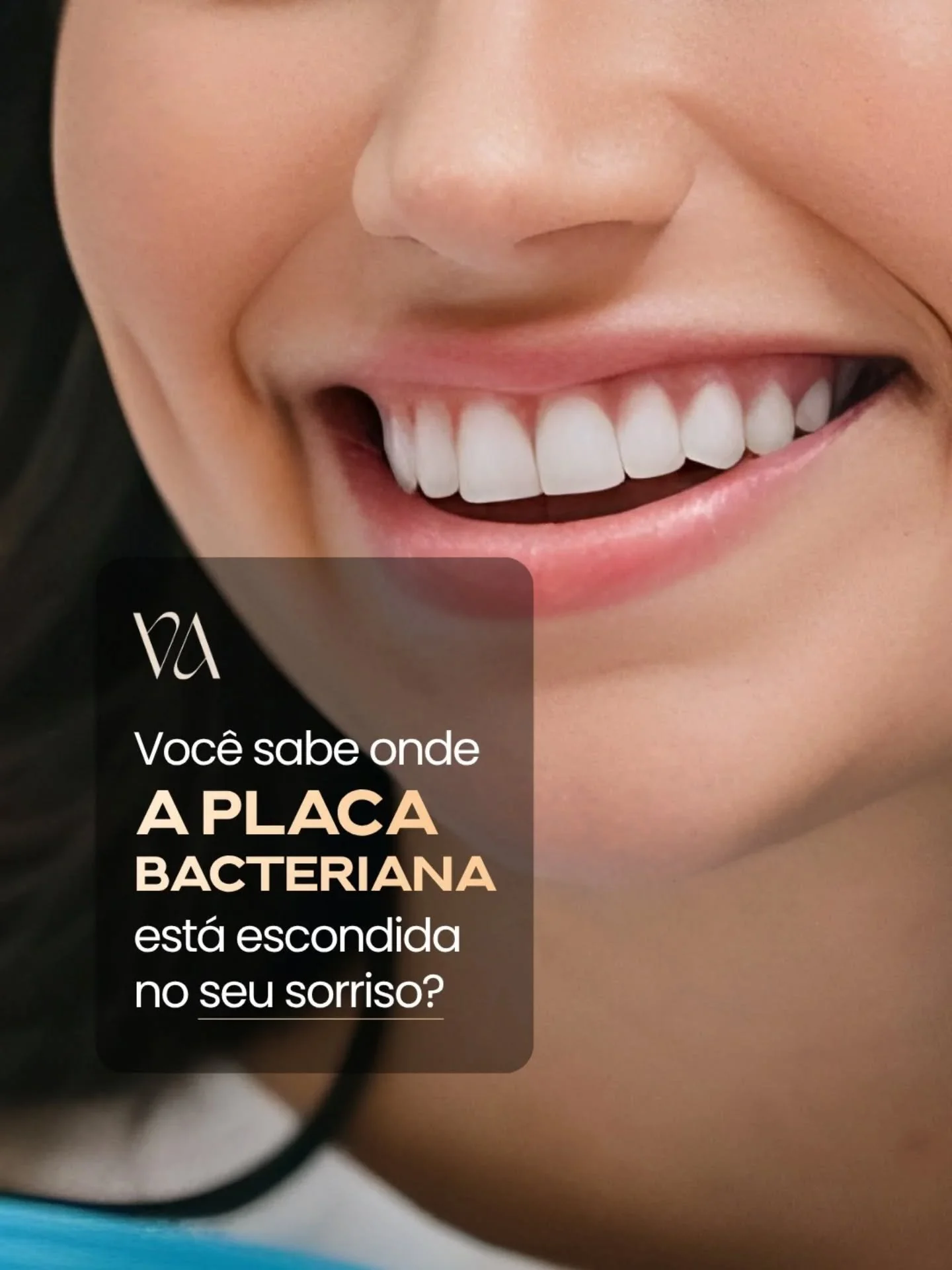 A placa bacteriana nem sempre aparece de forma vis&iacute;vel, e &eacute; exatamente isso que torna o problema t&atilde;o comum. 🦷⚠️

Mesmo escovando os dentes todos os dias, existem regi&otilde;es onde o ac&uacute;mulo acontece com facilidade, prin