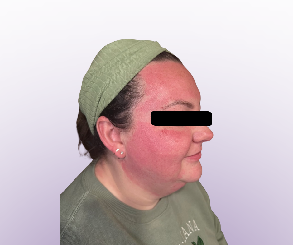 Microneedling Party_5.png