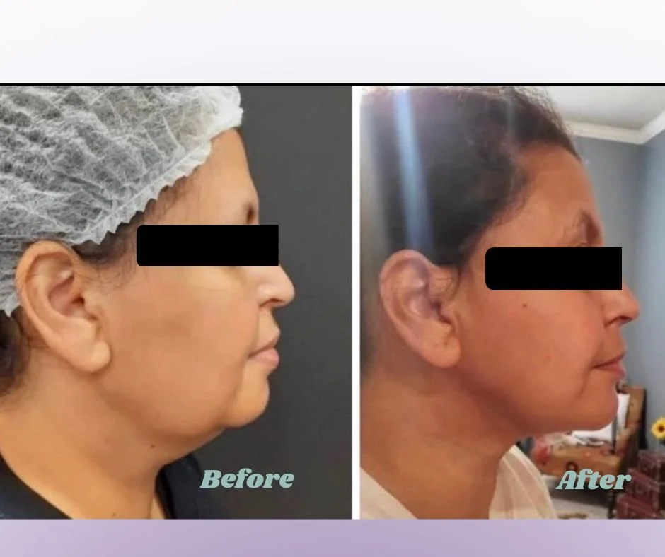 Zilene Before and After Facebook Post.jpg