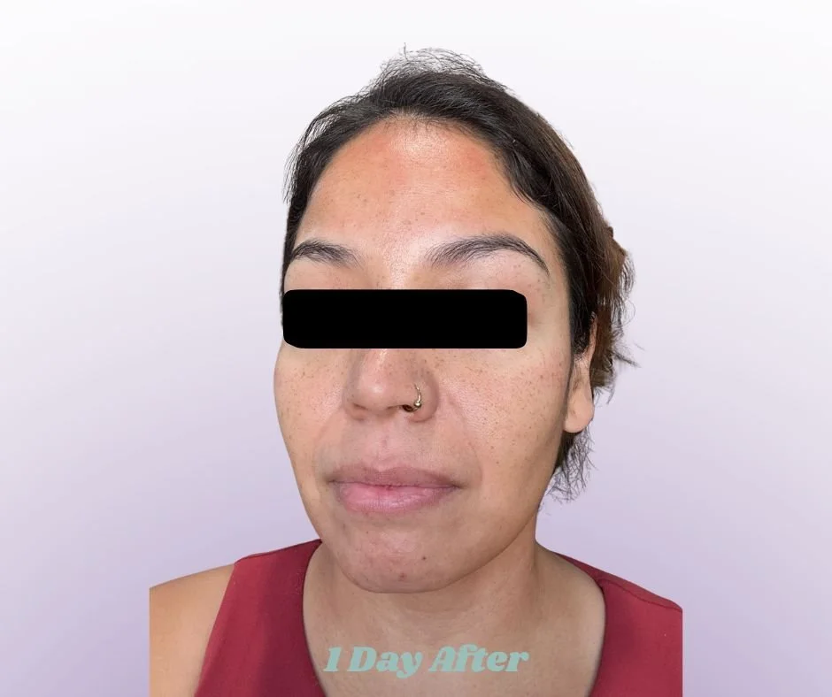 Michelle One Day Post Microneedling - FB Post.jpg