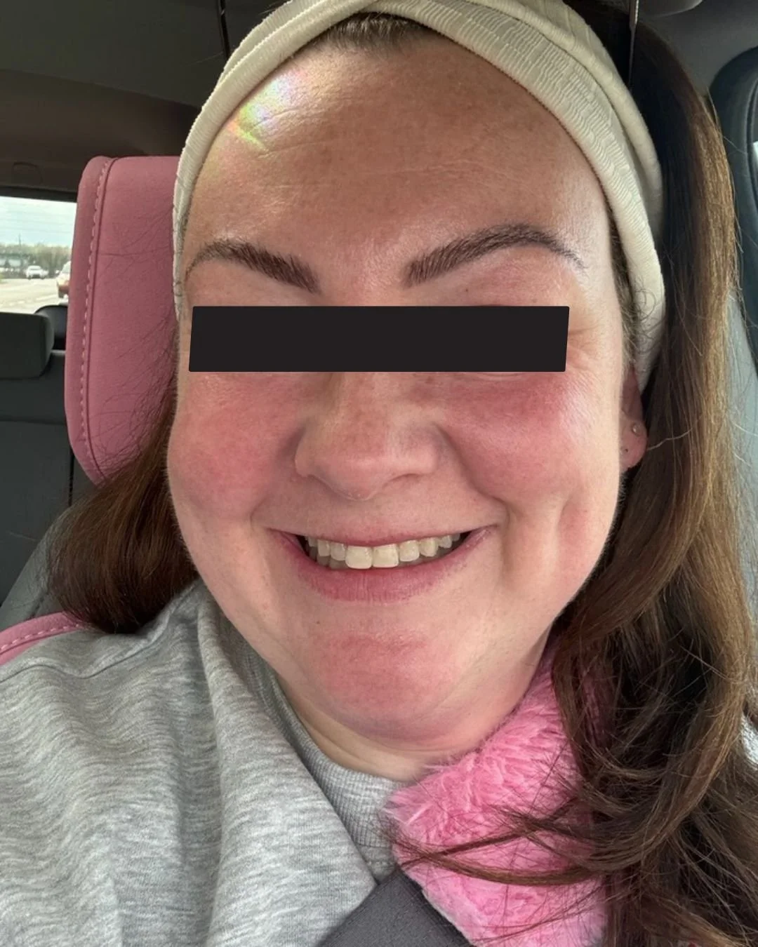 Microneedling After Effect .jpg