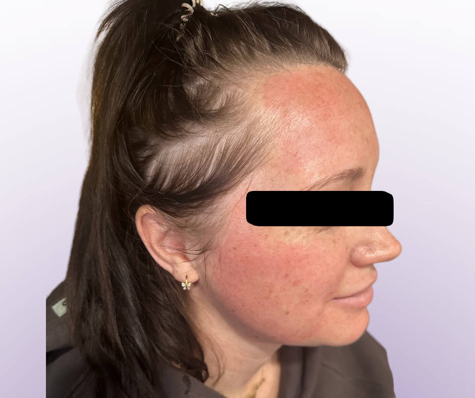 Microneedling Party_3.png