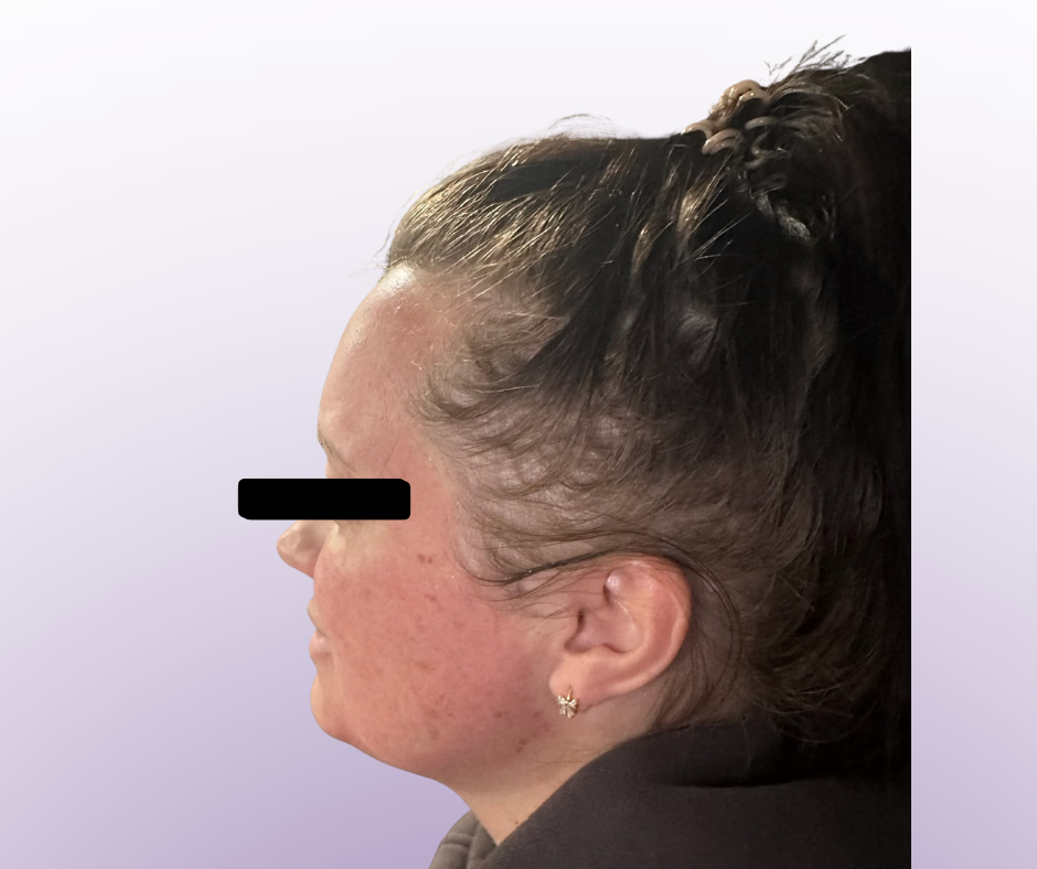 Microneedling Party_4.png