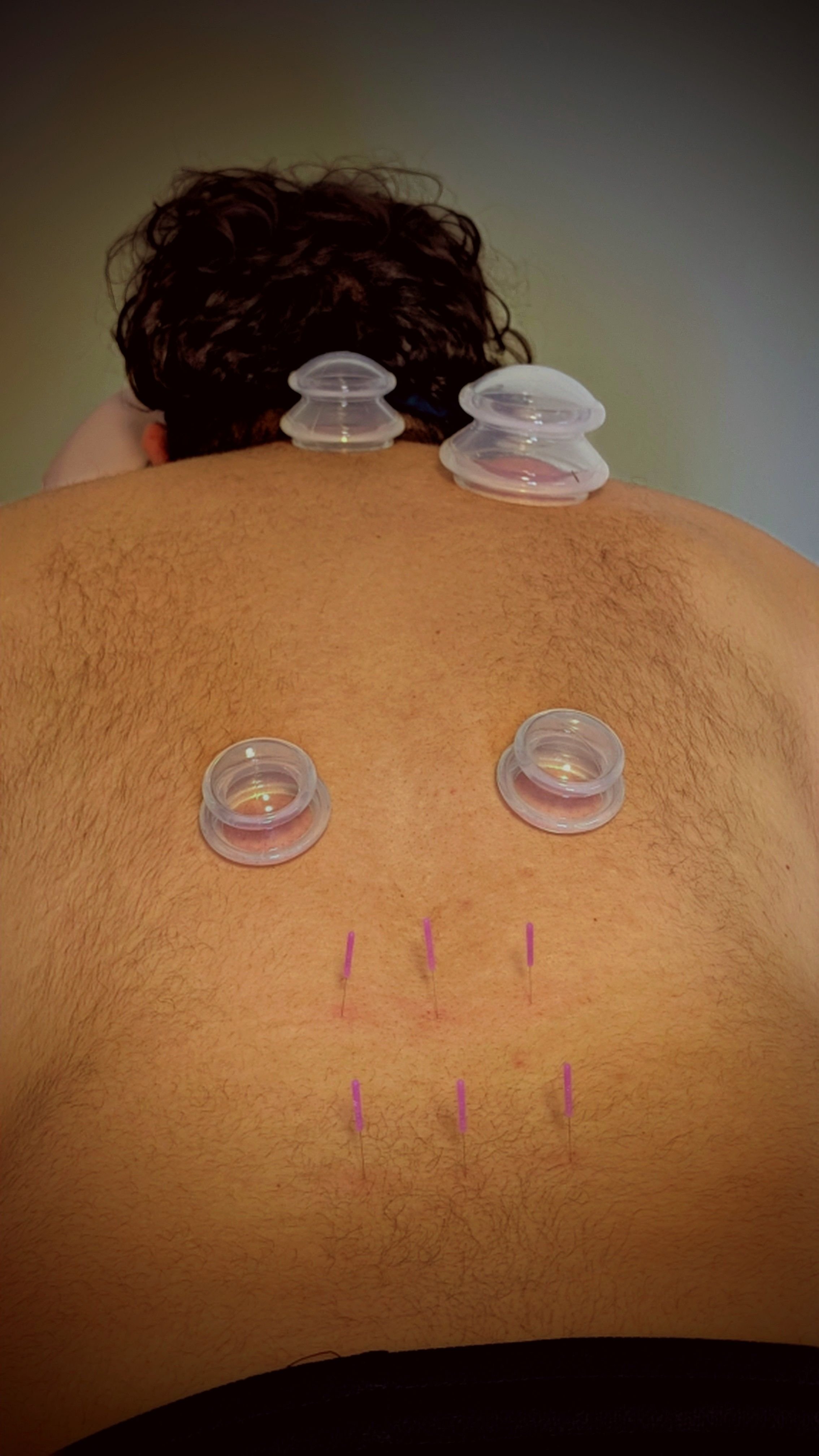 Cupping and acupuncture for back pain