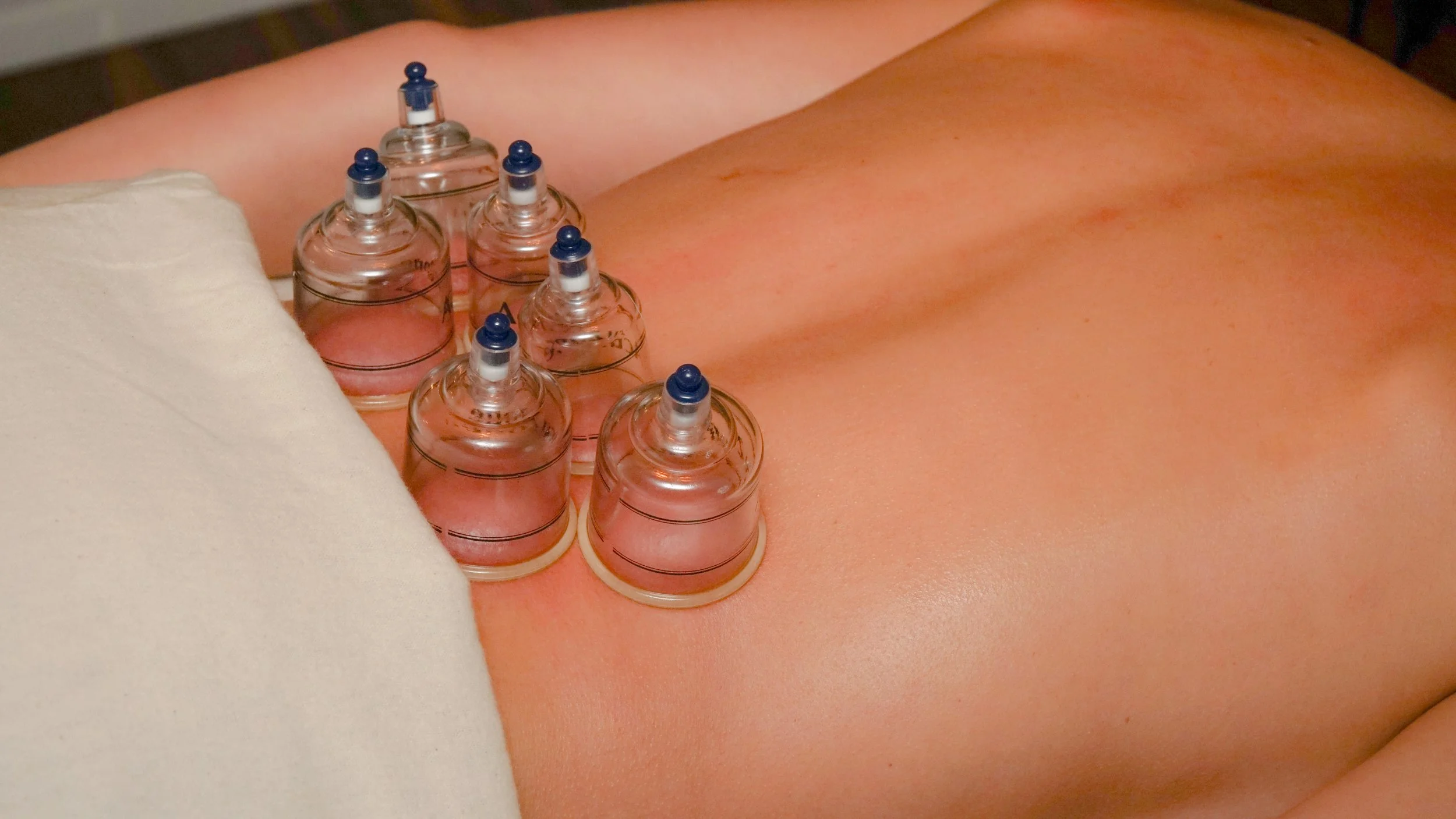 A person receiving cupping therapy with six glass cups placed on their back.