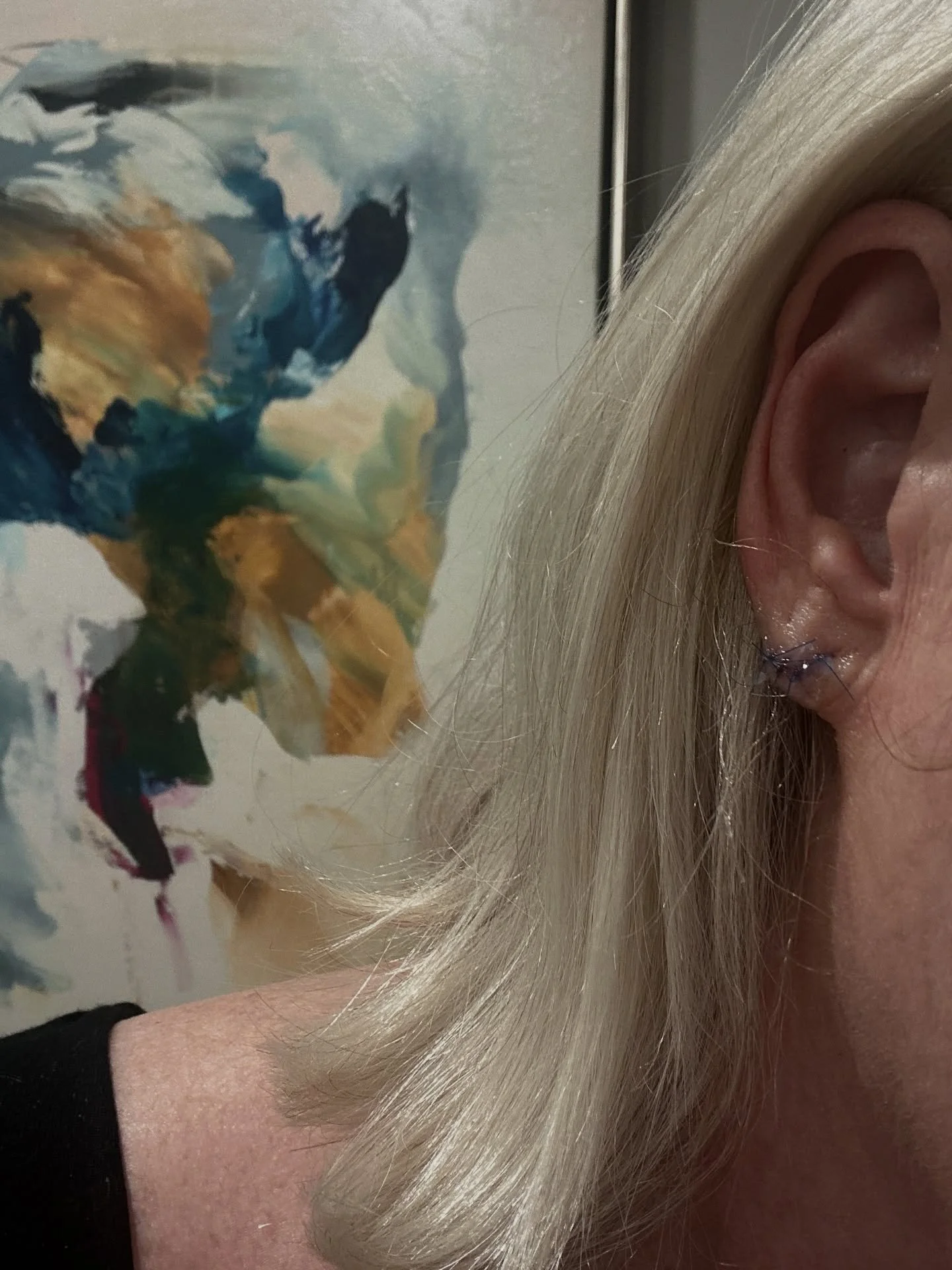 What did I do today, you ask? And what the heck is this photo of?!?

Well, I had an earlobe rejuvenation today with the incredible @drcassiehartline! My main reason was to fix the incredibly long &ldquo;holes&rdquo; from 50 years of tugging on my ear