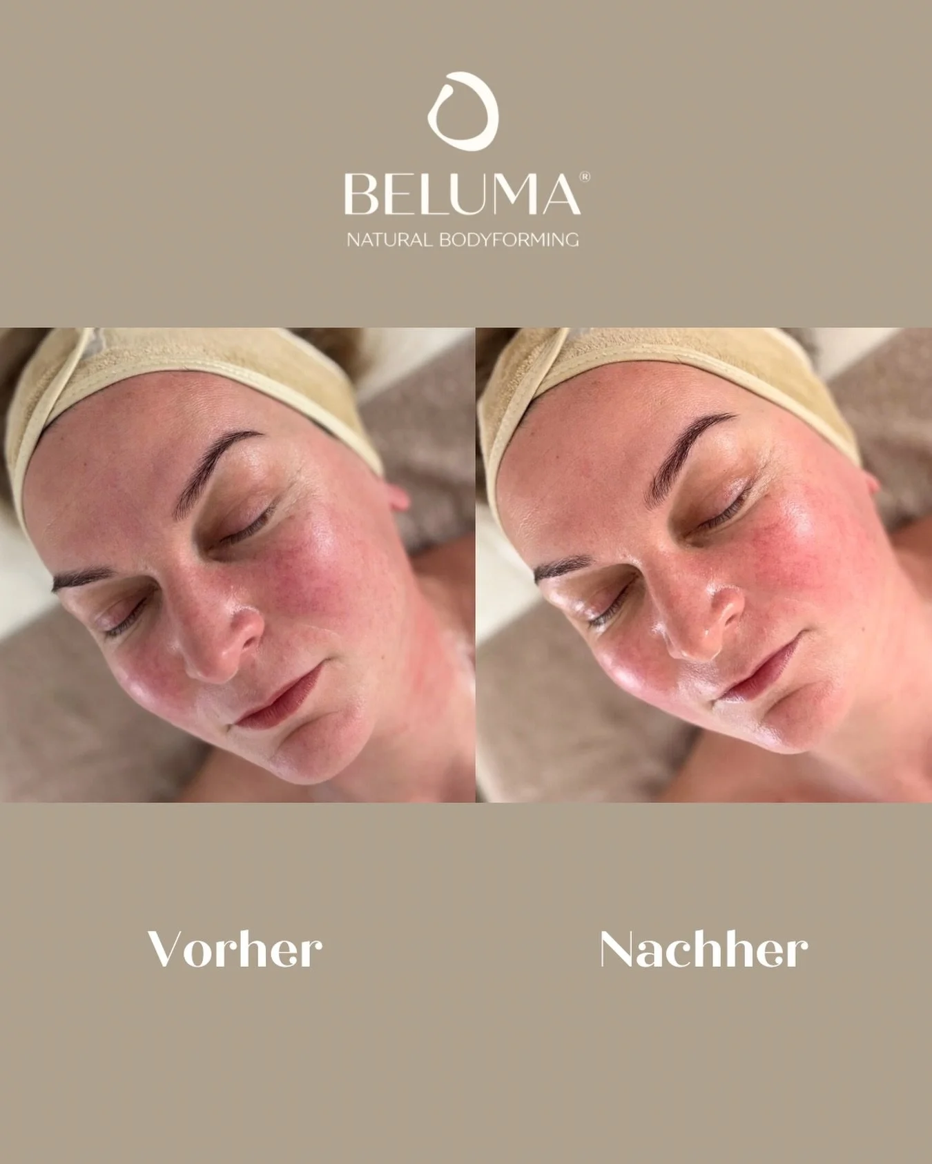 ✨ Manchmal braucht die Haut keine Filter &ndash; sondern die richtige Aktivierung.

Was du hier siehst, ist der direkte Effekt gezielter manueller Techniken.

Durch die Kombination aus Kobido Face Lifting und aktivierender Lymphstimulation wird die M