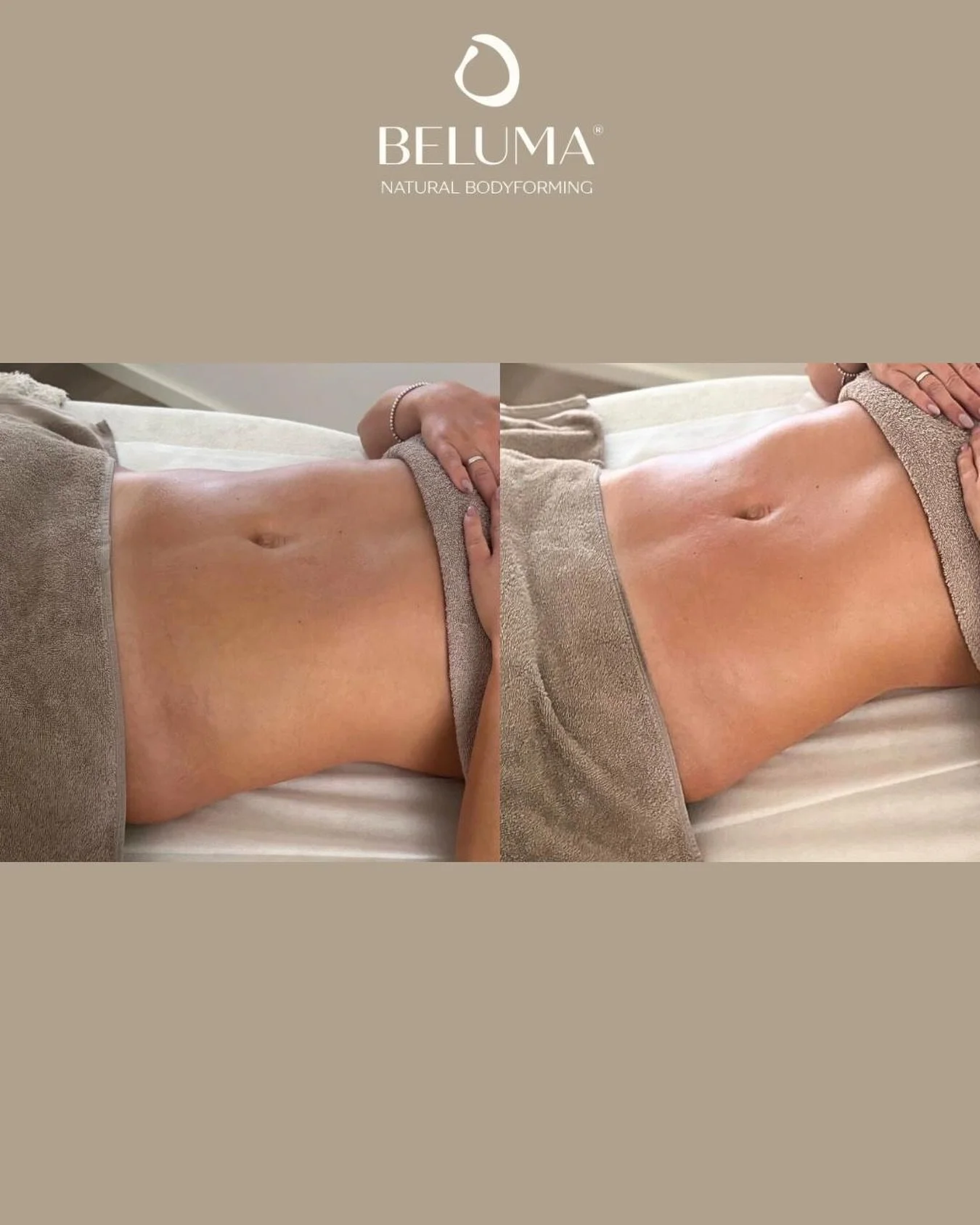 Nach nur einer brasilianischen Lymphdrainage ✨
weniger Schwellung, mehr Definition &amp; ein sichtbar flacherer Bauch.

Viele untersch&auml;tzen, wie stark Wassereinlagerungen den K&ouml;rper beeinflussen k&ouml;nnen &ndash; genau hier setzt die Beha
