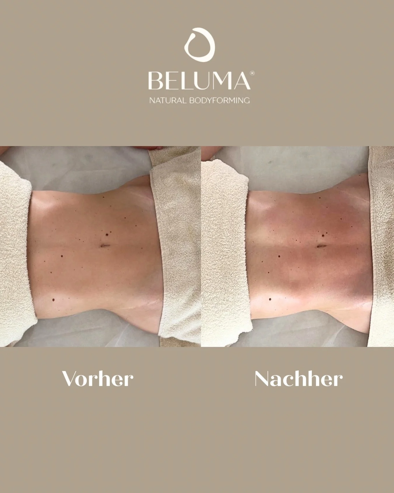 Schon nach der ersten Behandlung sichtbar ✨
Weniger Schwellungen, definiertere Konturen und ein sichtbar entlastetes Gewebe &ndash; dieses Ergebnis zeigt, was gezielte brasilianische Lymphdrainage bewirken kann.

Viele untersch&auml;tzen, wie stark e