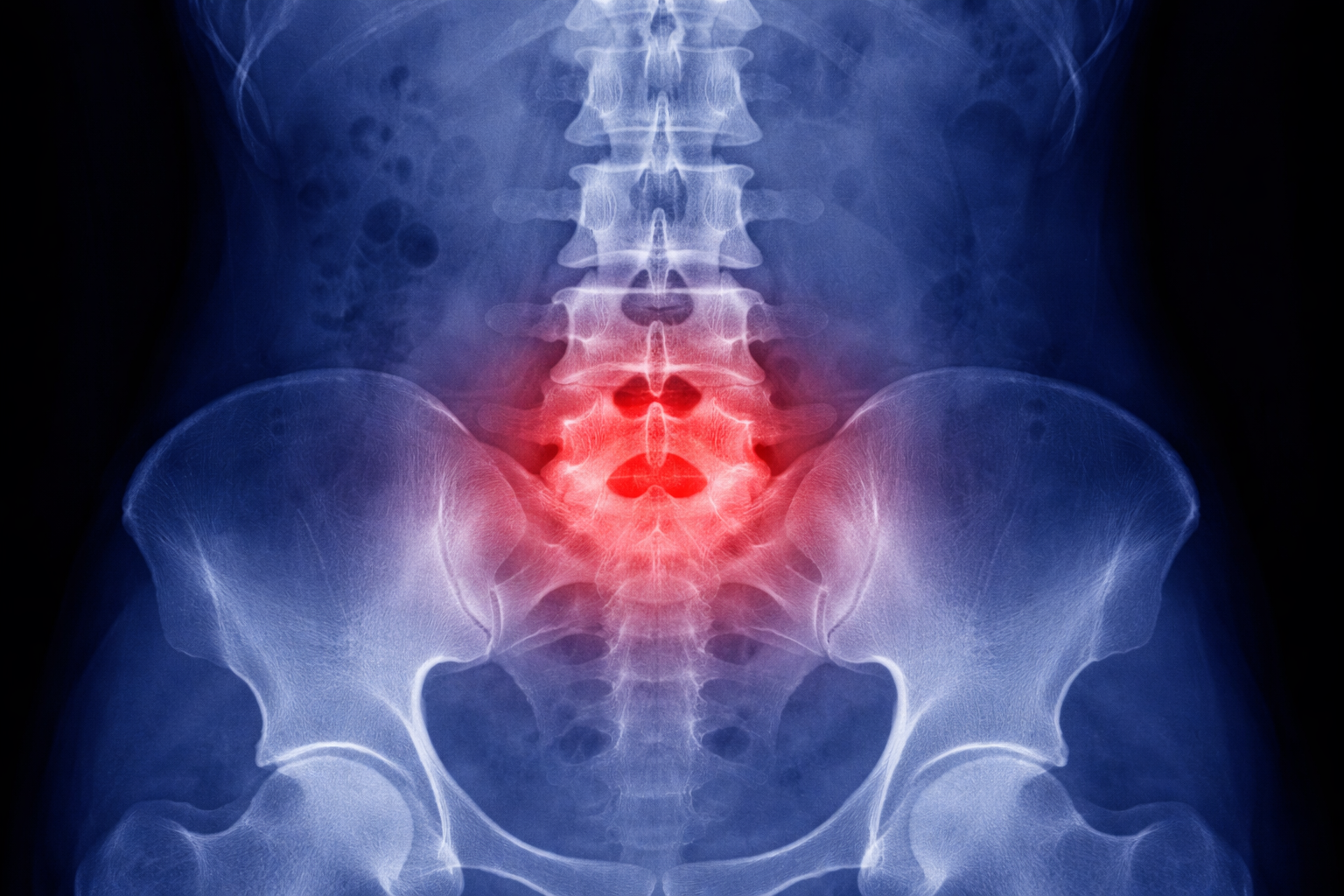 Lower Back Strain
