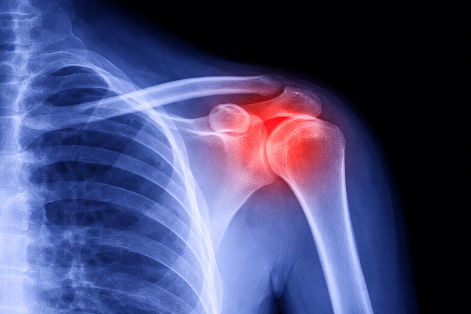Little League Elbow/Shoulder