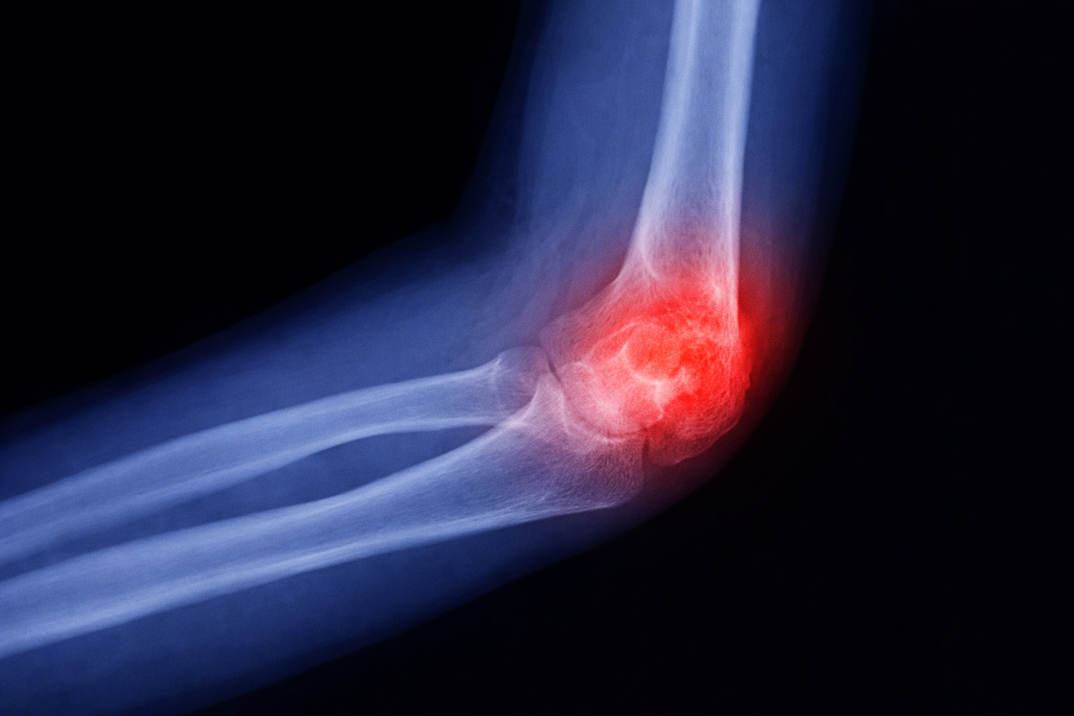 Tennis/Golfer’s Elbow