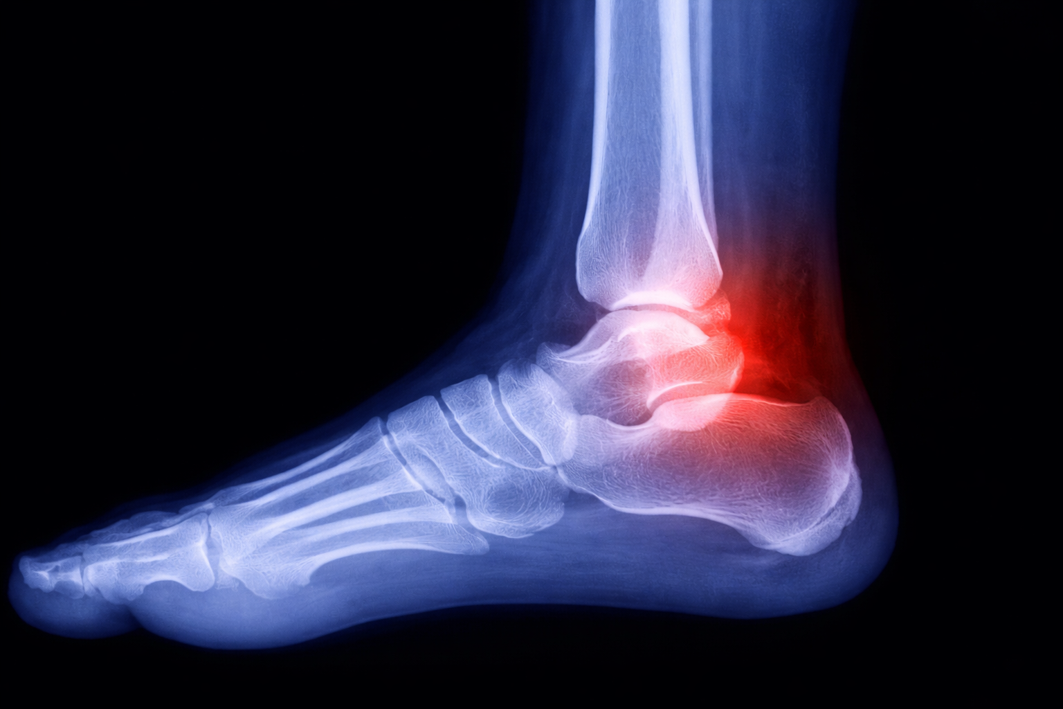 Ankle Sprains