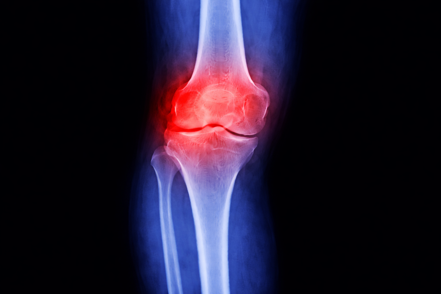 ACL/MCL Ligament Tears