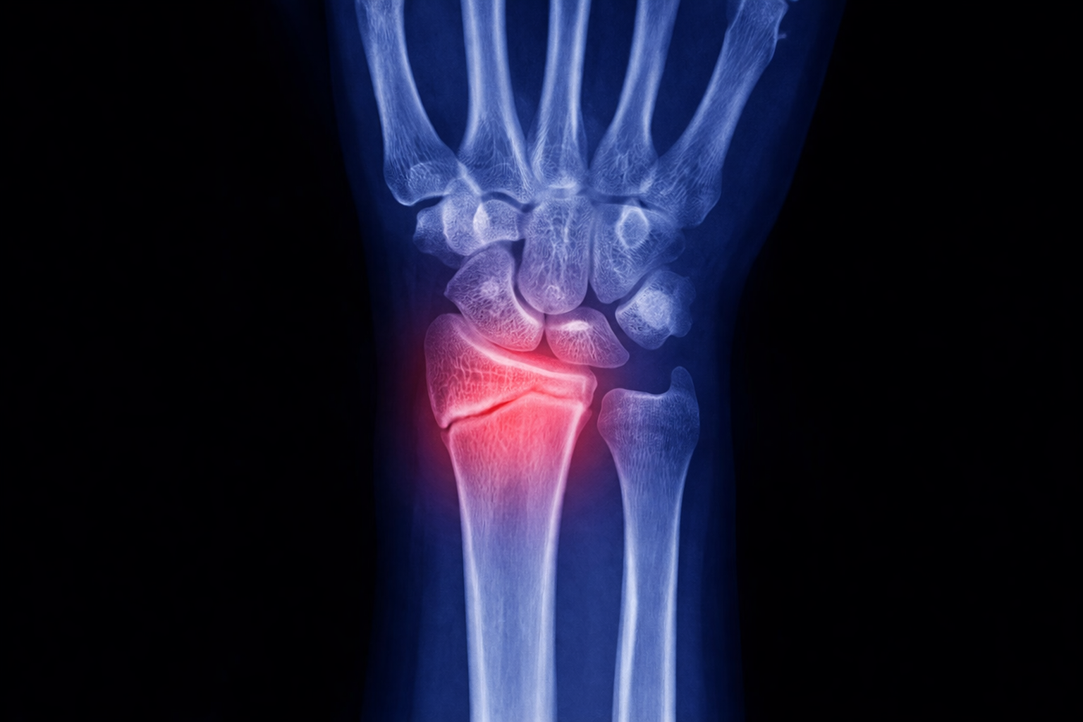 Wrist/Ankle Fractures