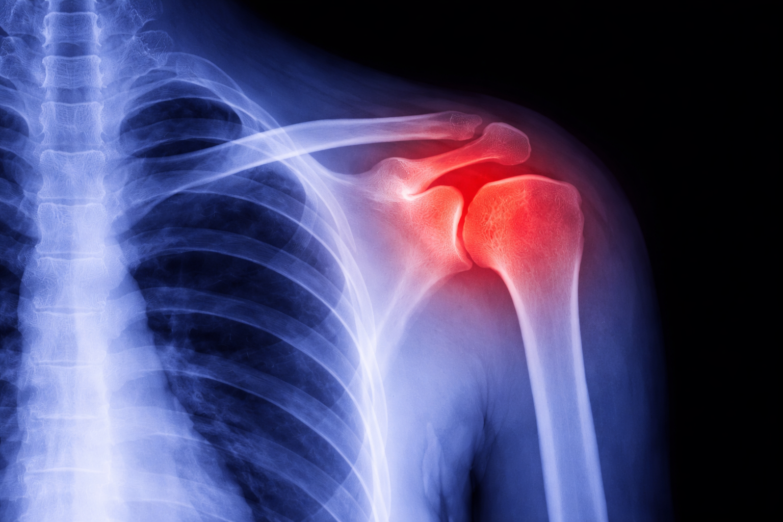 Shoulder Dislocation