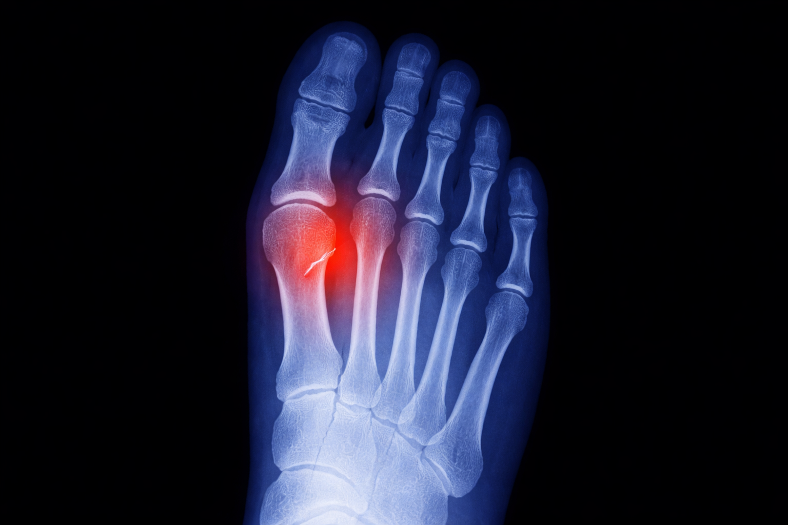 Stress Fractures