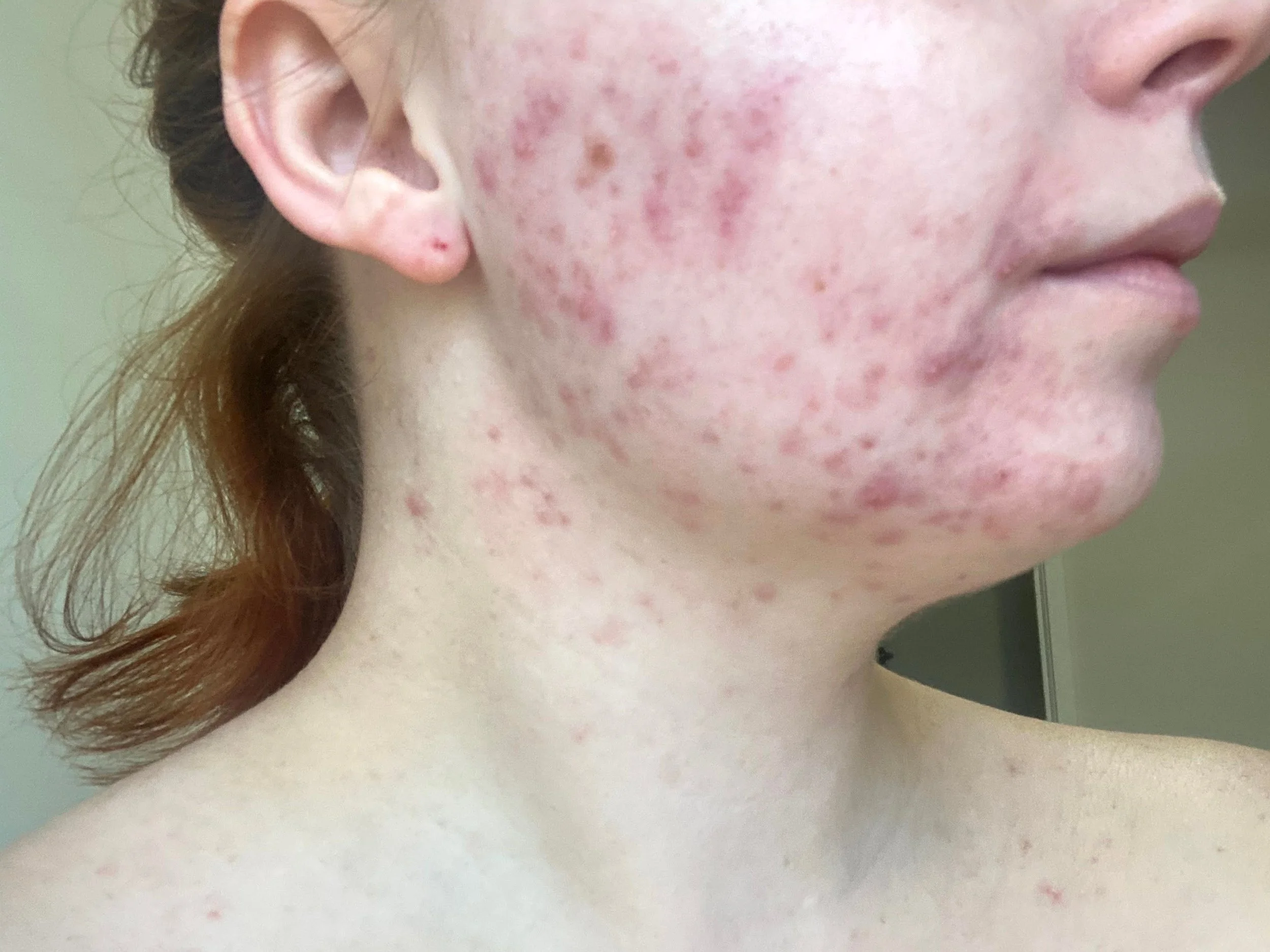 before image of hormonal acne on samantha elle, prior to using sabbia co skincare