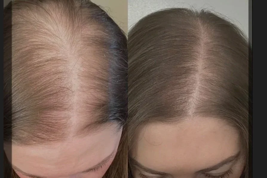 Comparison of a woman's hair before and after hair restoration, showing increased hair density and coverage in the after photo.