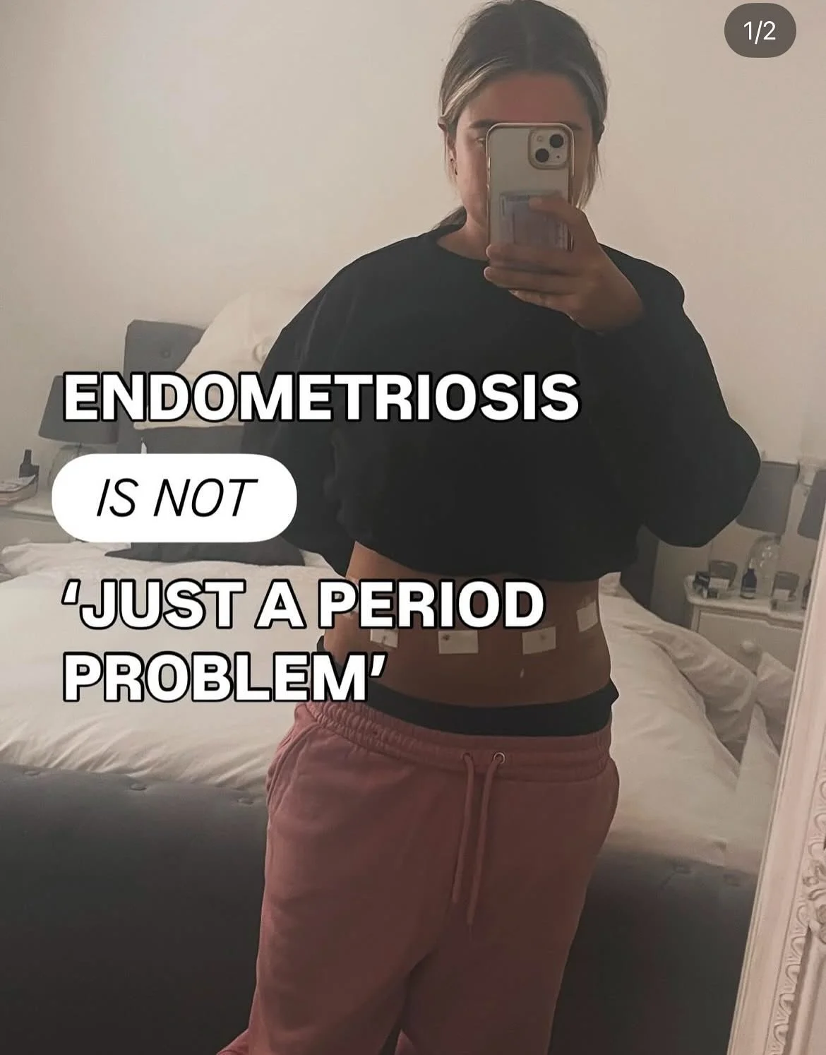 Endometriosis is not ‘just a period problem’ - it’s so much more! 
Endo can still grow even without a person having periods or without a uterus.
It is a complex condition, often rooted in chronic inflammation and full body immune