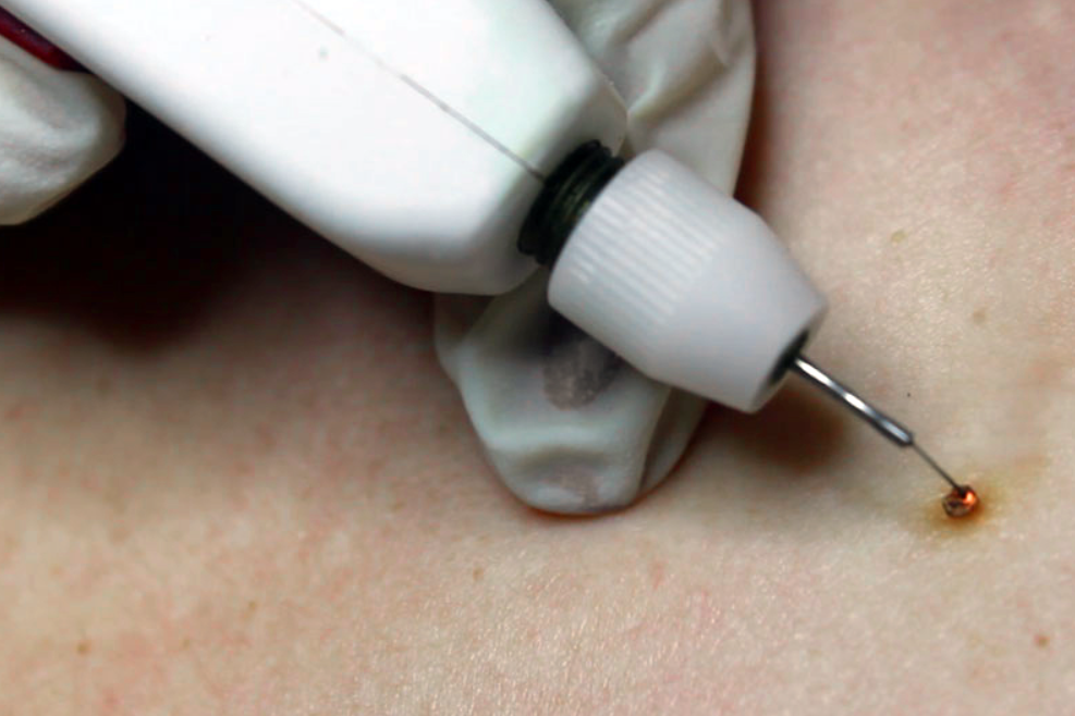 Diciamo addio al bisturi