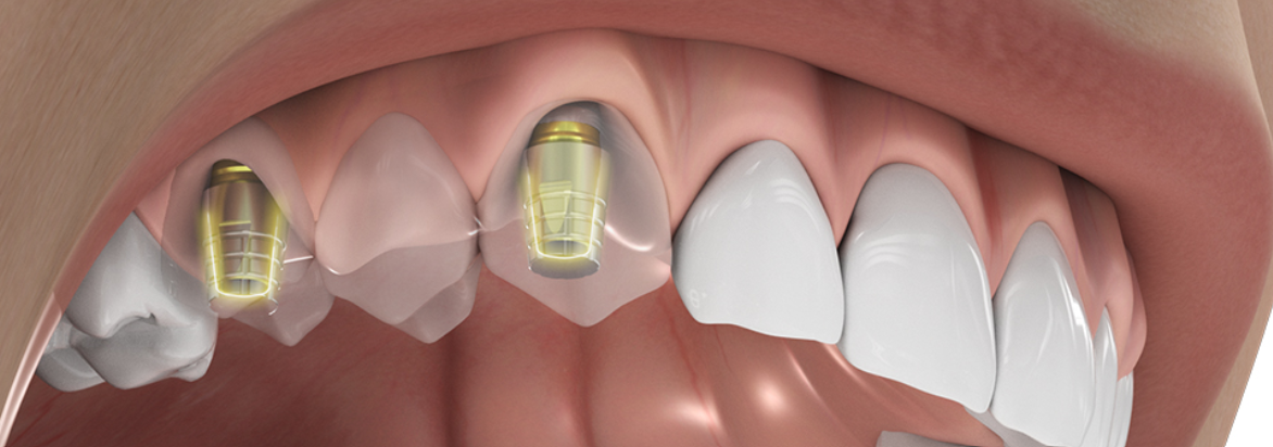Conometria e accoppiamento telescopico