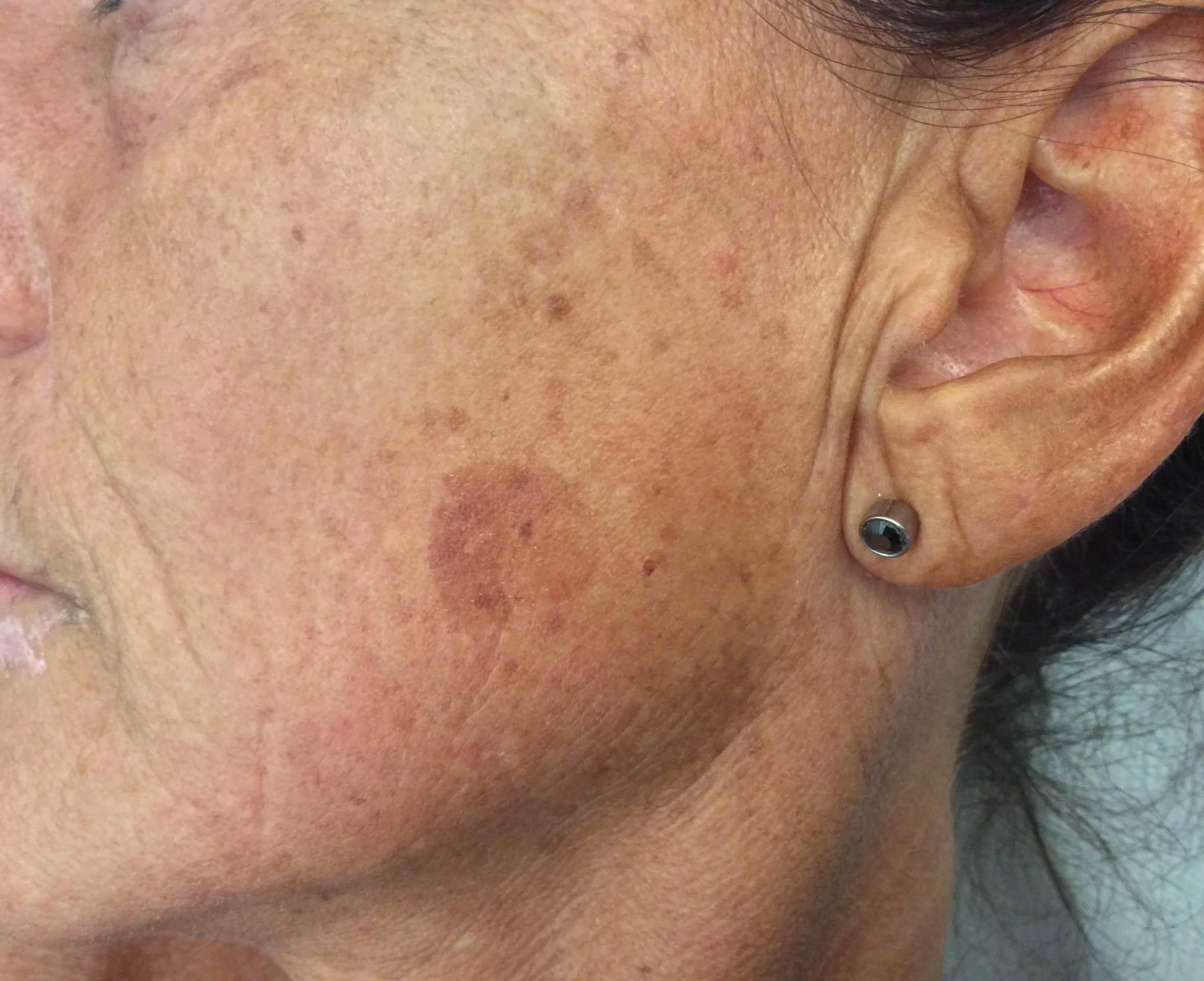 Le macchie solari. Riconoscerle, prevenirle, curarle