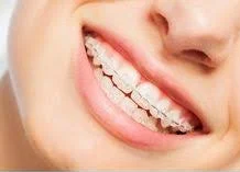 Ortodonzia fissa e invisibile