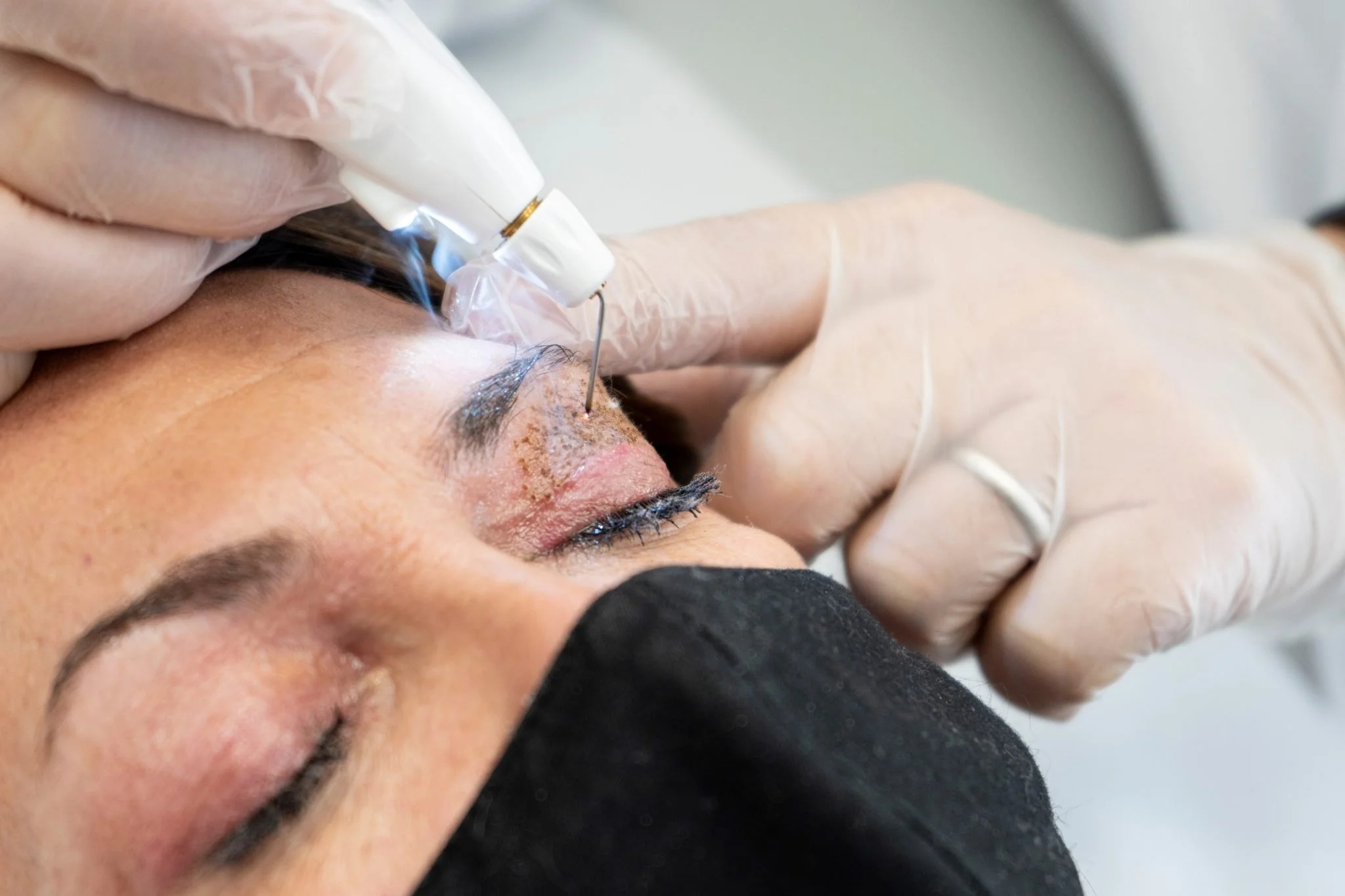 Una persona effettua un trattamento estetico al viso con l'uso di un dispositivo laser mentre indossa un guanto di lattice e viene aiutata da un professionista con altri guanti