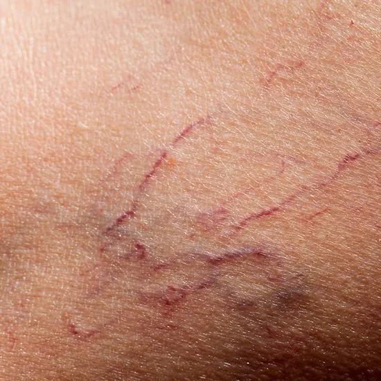 Close-up of scratched skin with several thin, red scratches.
