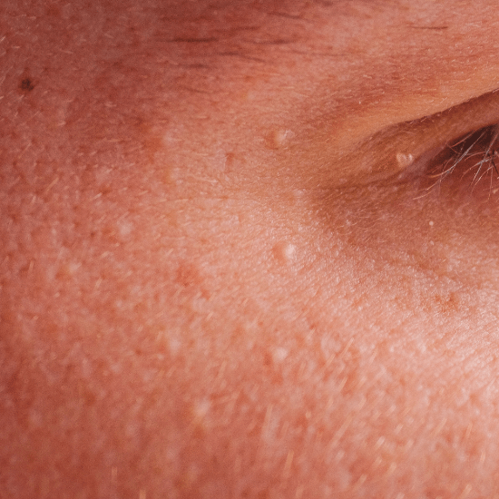 Close-up of a person's skin near the eye with visible pores and small white bumps.