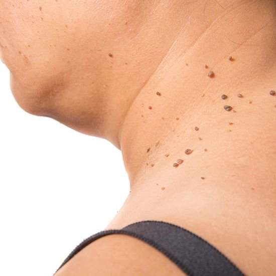 Close-up of a person's neck and shoulder with multiple small moles.