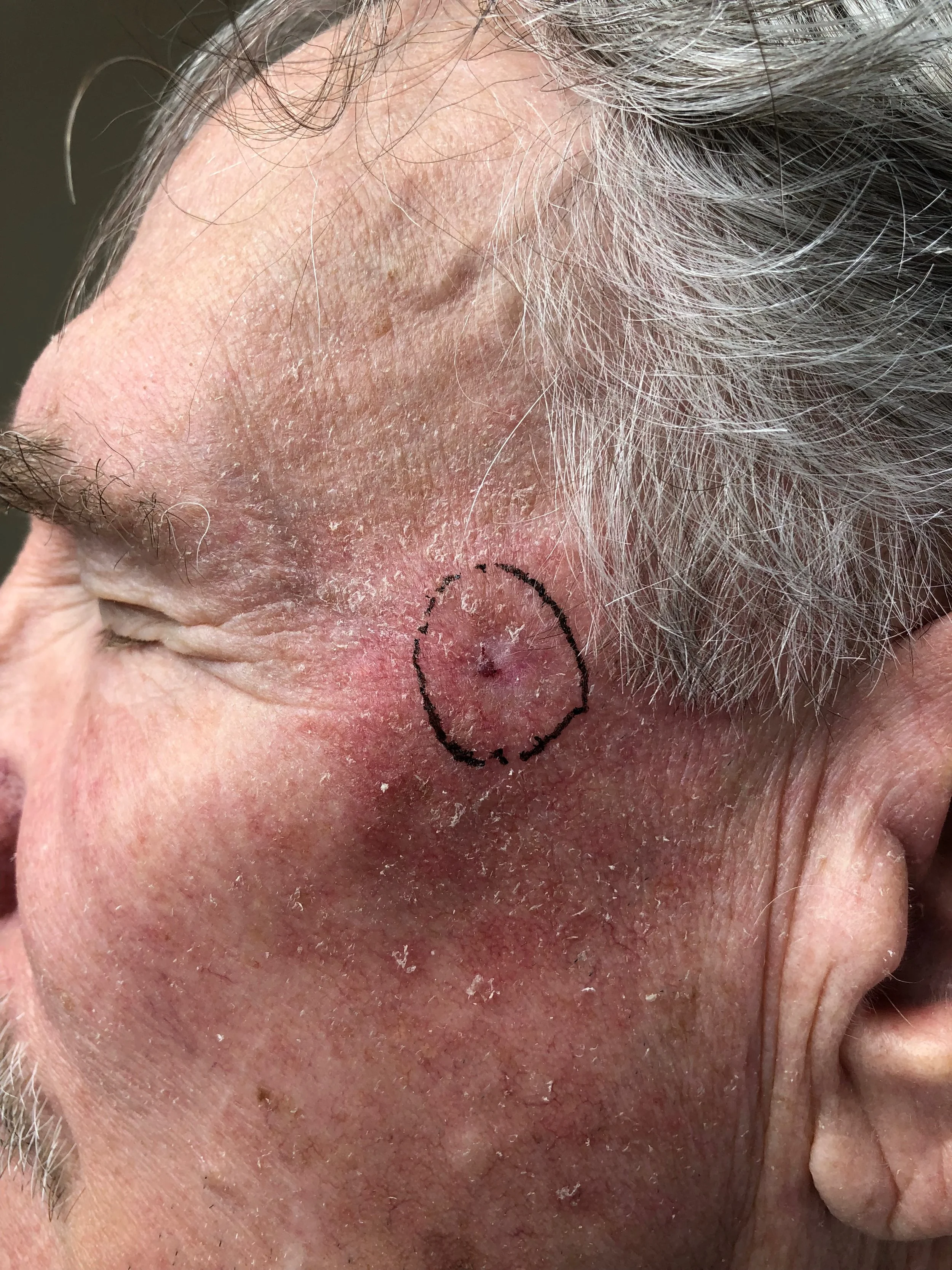 About Basal Cell Carcinoma