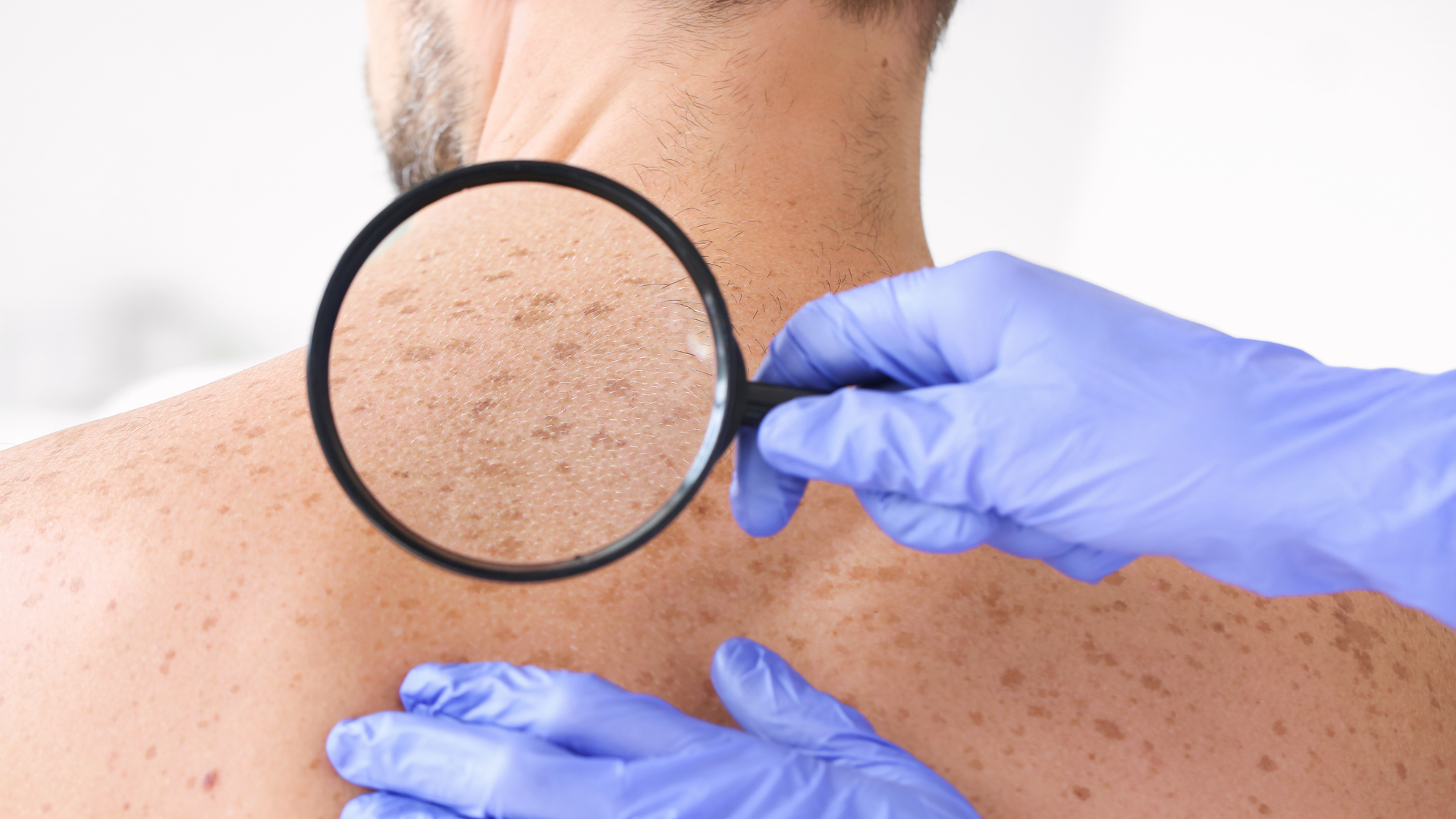 How to spot Melanomas and Atypical Moles